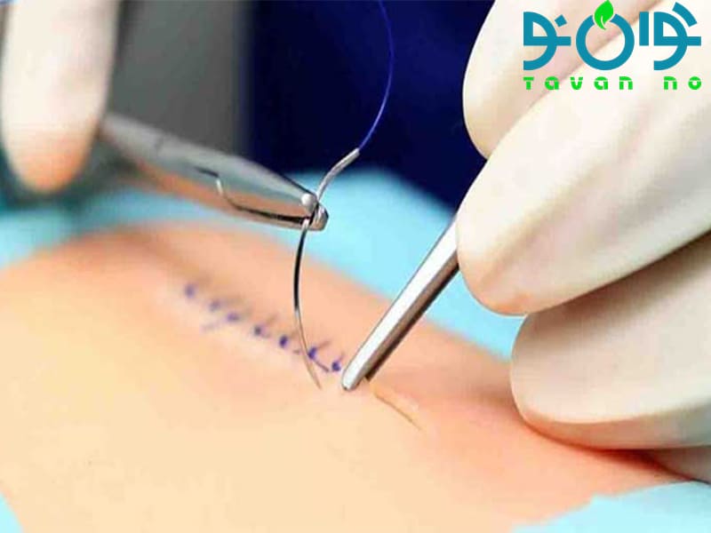 نخ بخیه چیست و چه کاربردها و انواعی در پزشکی دارد؟